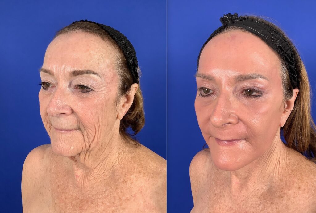 Croton oil peel before and after neck skin rejuvenation